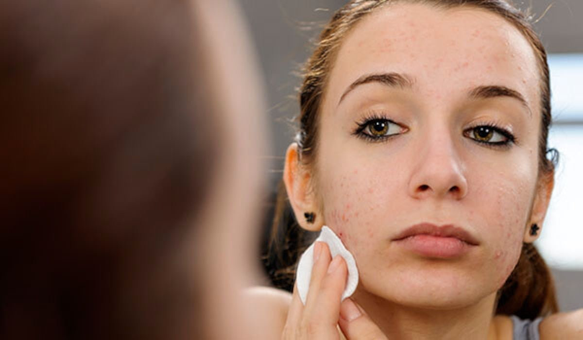 Does Collagen Help Blemishes?