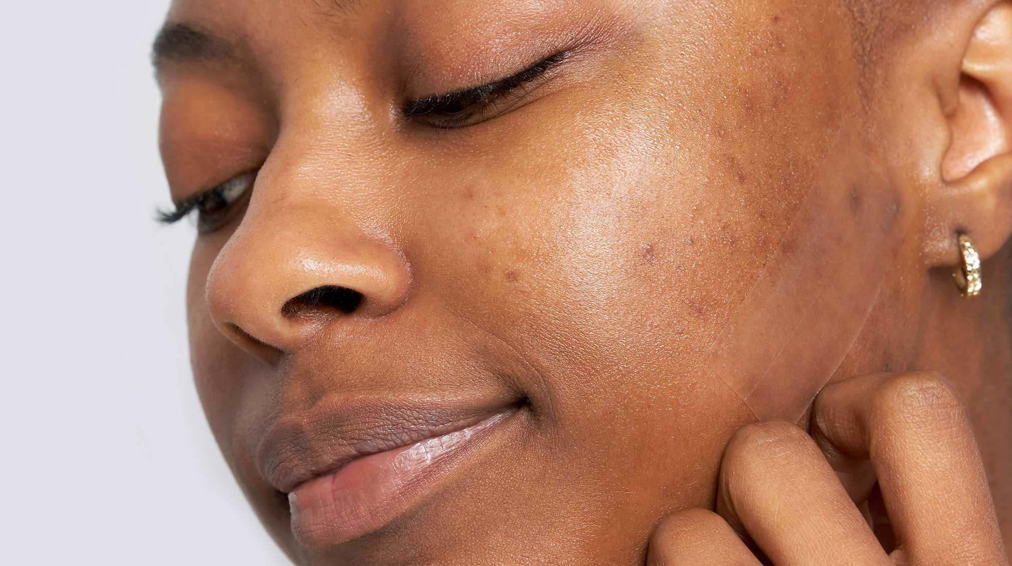 How to Manage Acne Scars