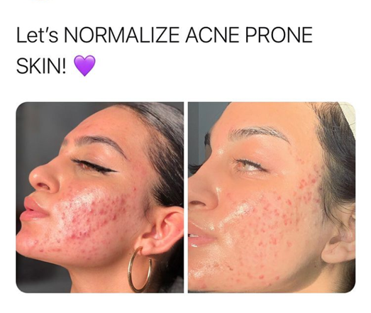 Ayesha shows her authentic skin. She glances to the sky with pride. The picture says: "Let's normalize normal skin!"