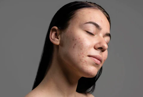 The 3 Best Products from The Ordinary for Acne