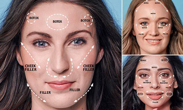 Botox Before And After Celebrity