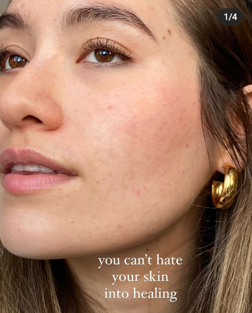 Christina looks up and smiles. She wears gold earrings. The picture reads: "You can't hate your skin into healing."