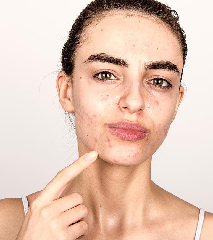 What Is the Difference between a Cyst and a Pimple?