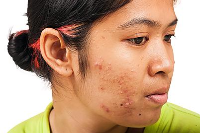 FAQ about Treating Acne-prone, Dry Skin