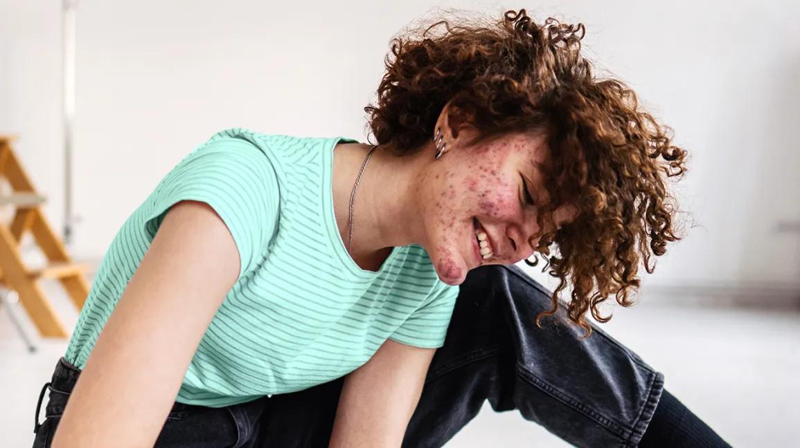 Our 5 Fave Acne Treatments under $10!