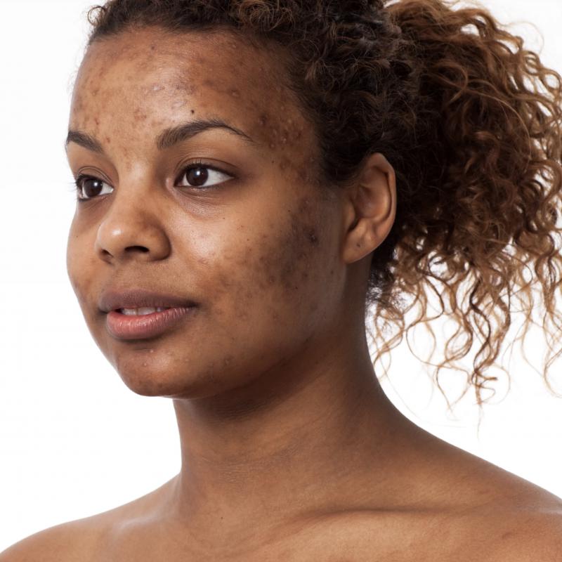 3 Ingredients That Stop Hyperpigmentation