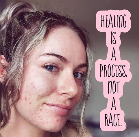 Laurel smiles as if she is reassuring someone. She wears her brown, blonder, and wavy hair into a ponytail. Her picture reads: Healing is a process, not a race.