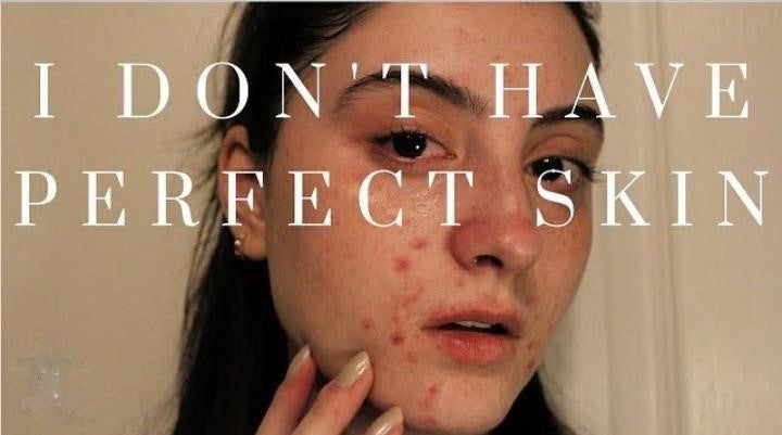 Lavinia: “I Don’t Have Perfect Skin, and That’s Okay.”