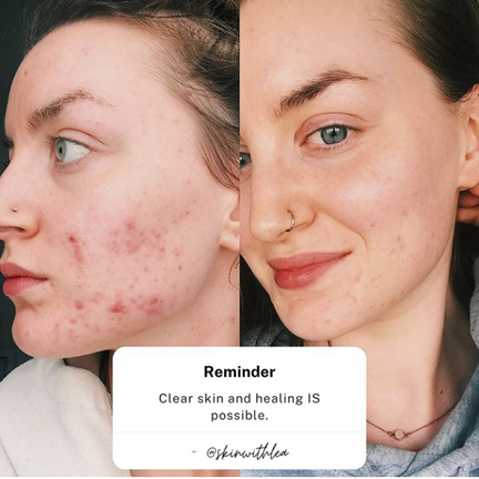 The picture shows a comparison of Lea looking solemn with red blemishes on her face, and the other picture shows less blemishes and she is giving a small smile. The text across both pictures read "reminder: clear skin and healing is possible." 