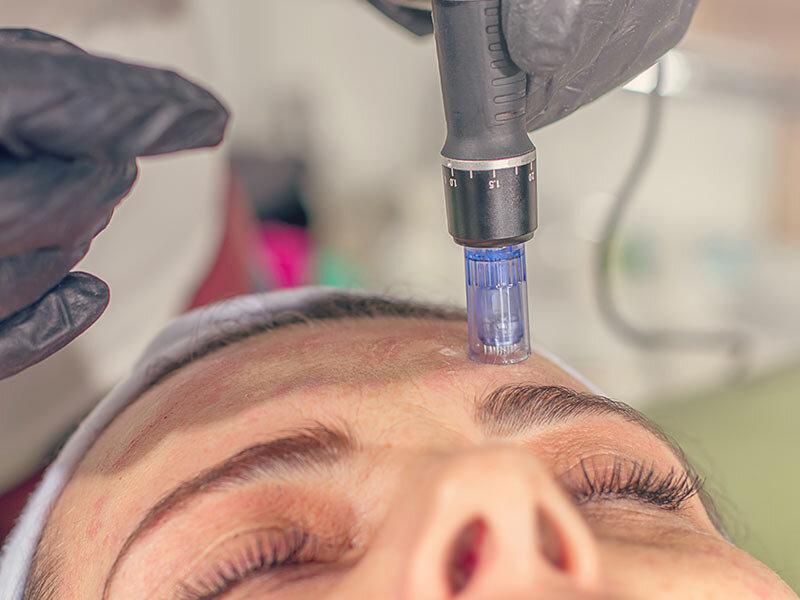 The Pros and Cons of DIY Microneedling