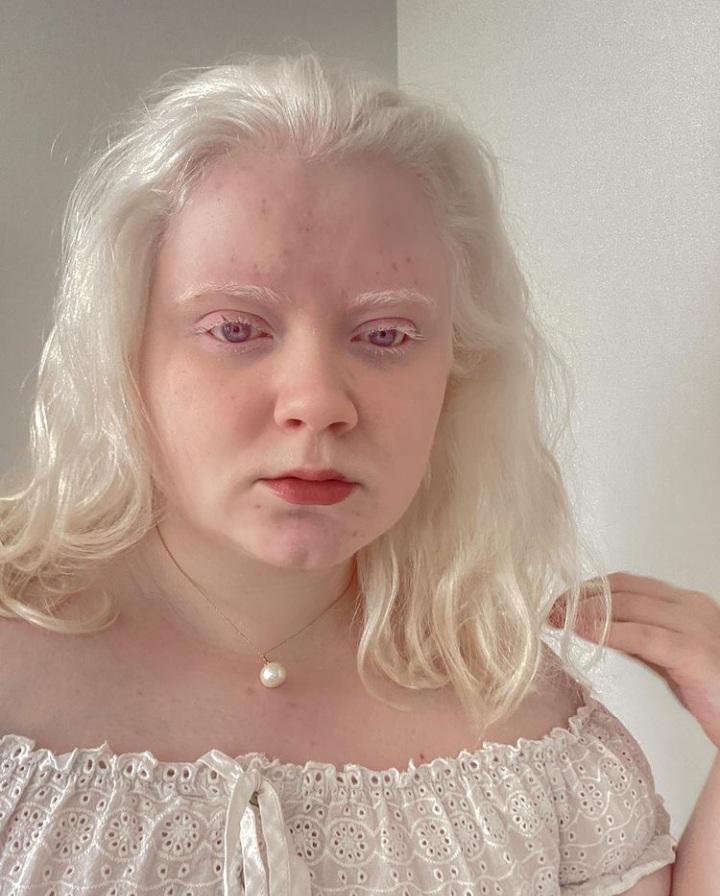 Oceanne: Beauty and Albinism: Breaking Free from Public Perception