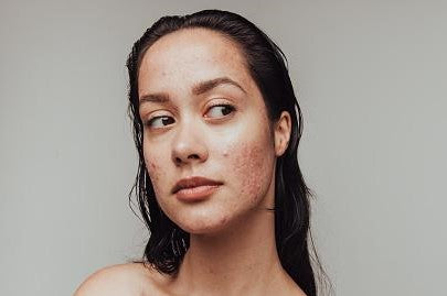 How Does Salicylic Acid Work for Acne?