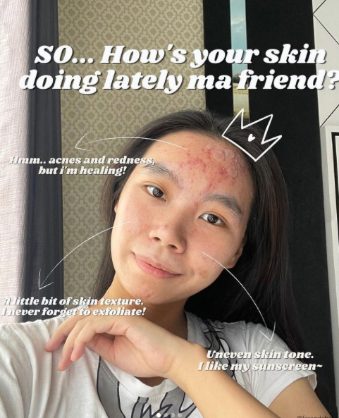 Ferend: Acne Skin = Normal Skin