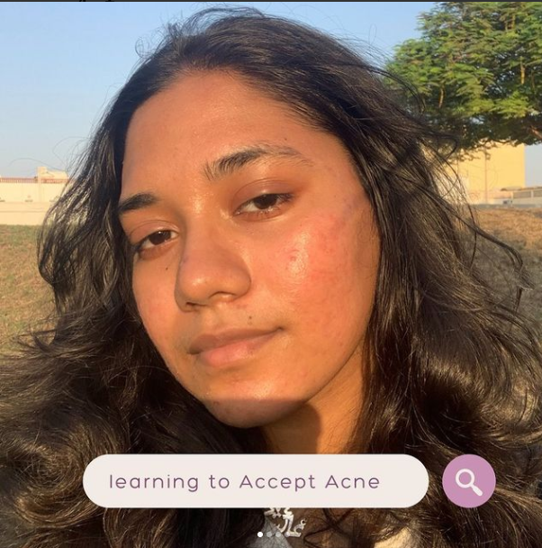 Asa: My Brown Skin Journey with Acne
