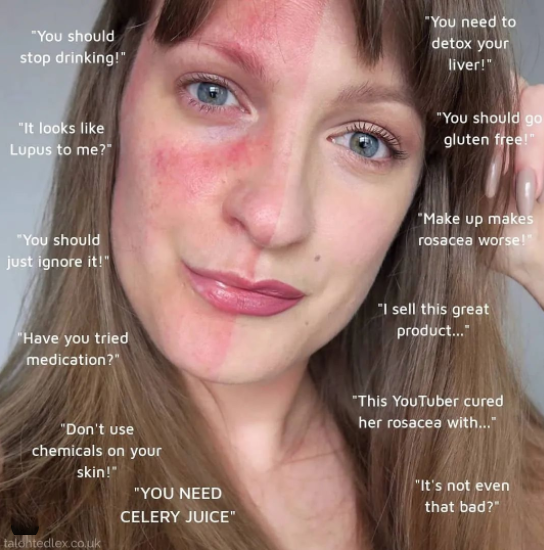 Lex Gillies: Ready to Love Myself with Rosacea