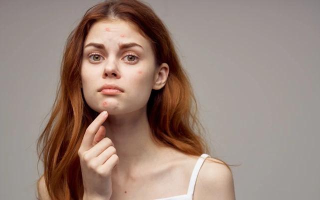 10 Skincare Products for Teenage Acne