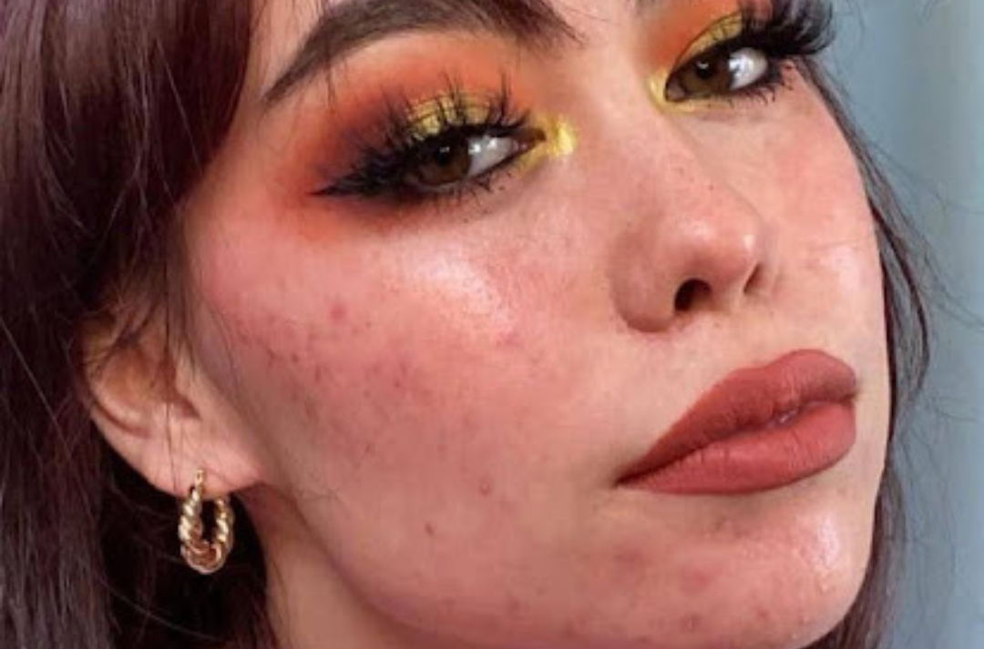 Jazzie: My acne is present, but so am I.