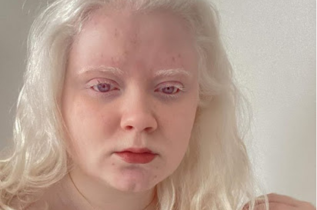 Oceanne: Beauty and Albinism: Breaking Free from Public Perception
