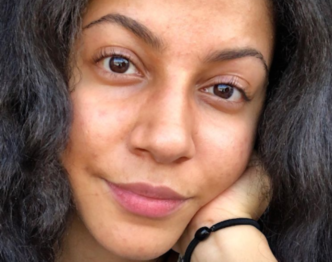 Ornella: Normal Skin Is Worthy.