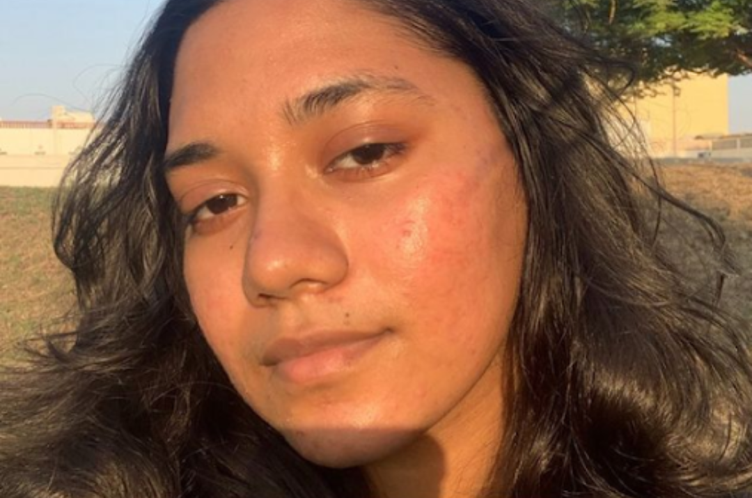 Asa: My Brown Skin Journey with Acne