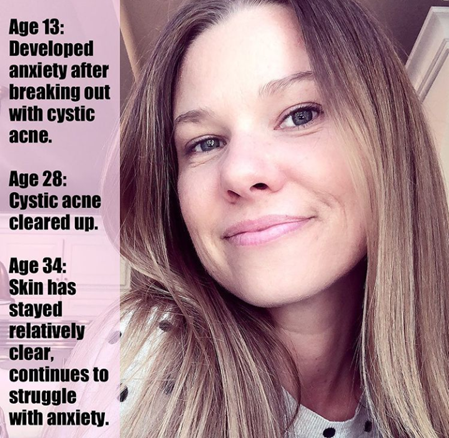 Wendy smiles, and there is text beside her describe the timeline of her story with acne. The illustration indicates that she still smiles even though she had to endure certain things.
