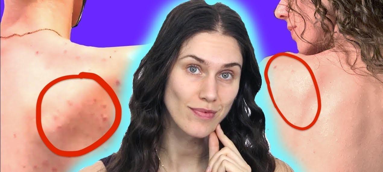 Cassandra’s Body Acne Routine