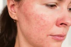 The Truth about Fungal Acne. Here’s What It Really Is. - Cassandra Bankson