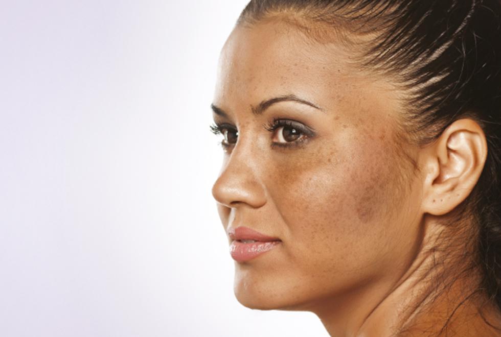 What Are Some OTC Ingredients for Melasma?