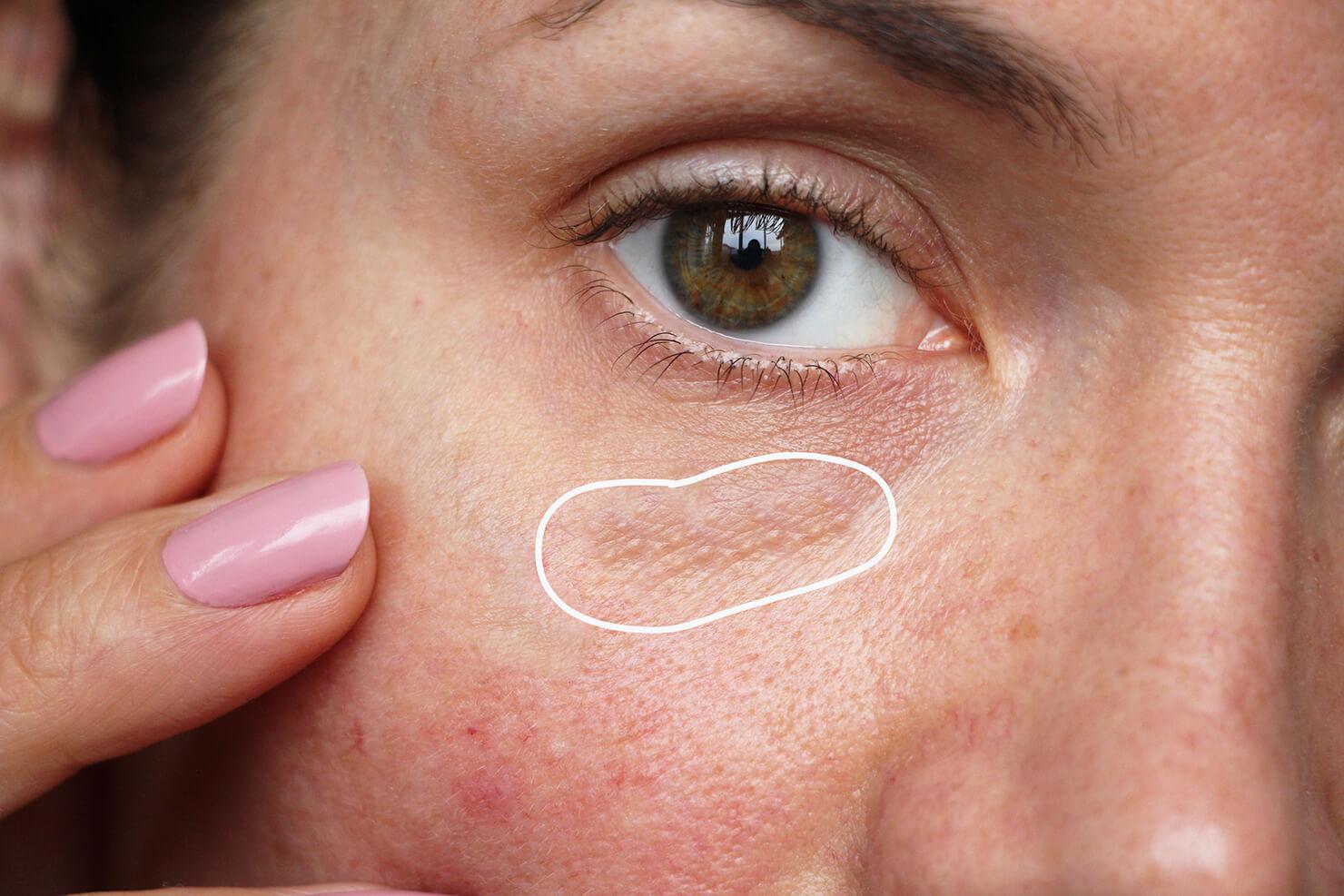 Do You Have Milia? Here Are 3 of the Best Gentle and Effective Eye Creams.
