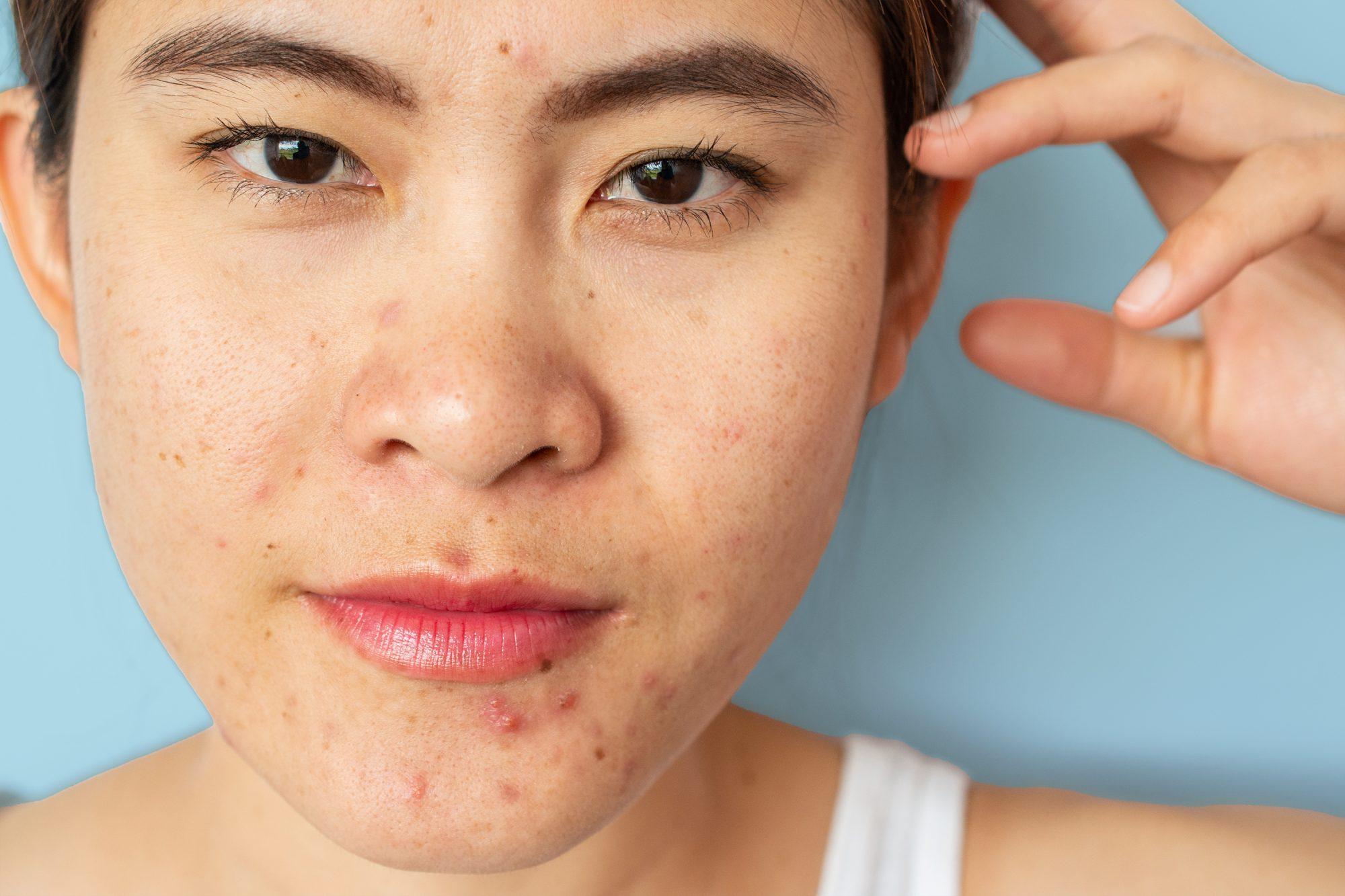 What Does Niacinamide Do for the Skin Barrier?