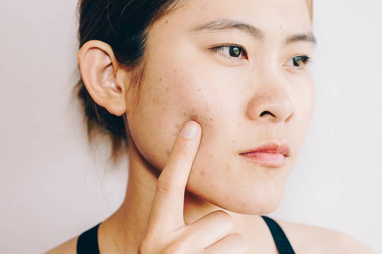 5 Things People Don't Realize Are Triggering Their Acne