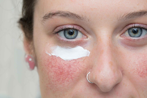 How Does Azelaic Acid Work on Skin?