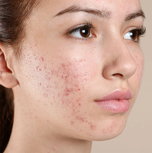 Here Are The Four Ingredients Medically Proven to Treat Acne