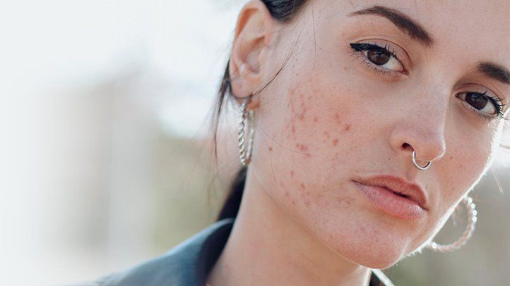 3 Comforting Thoughts When You Have Acne