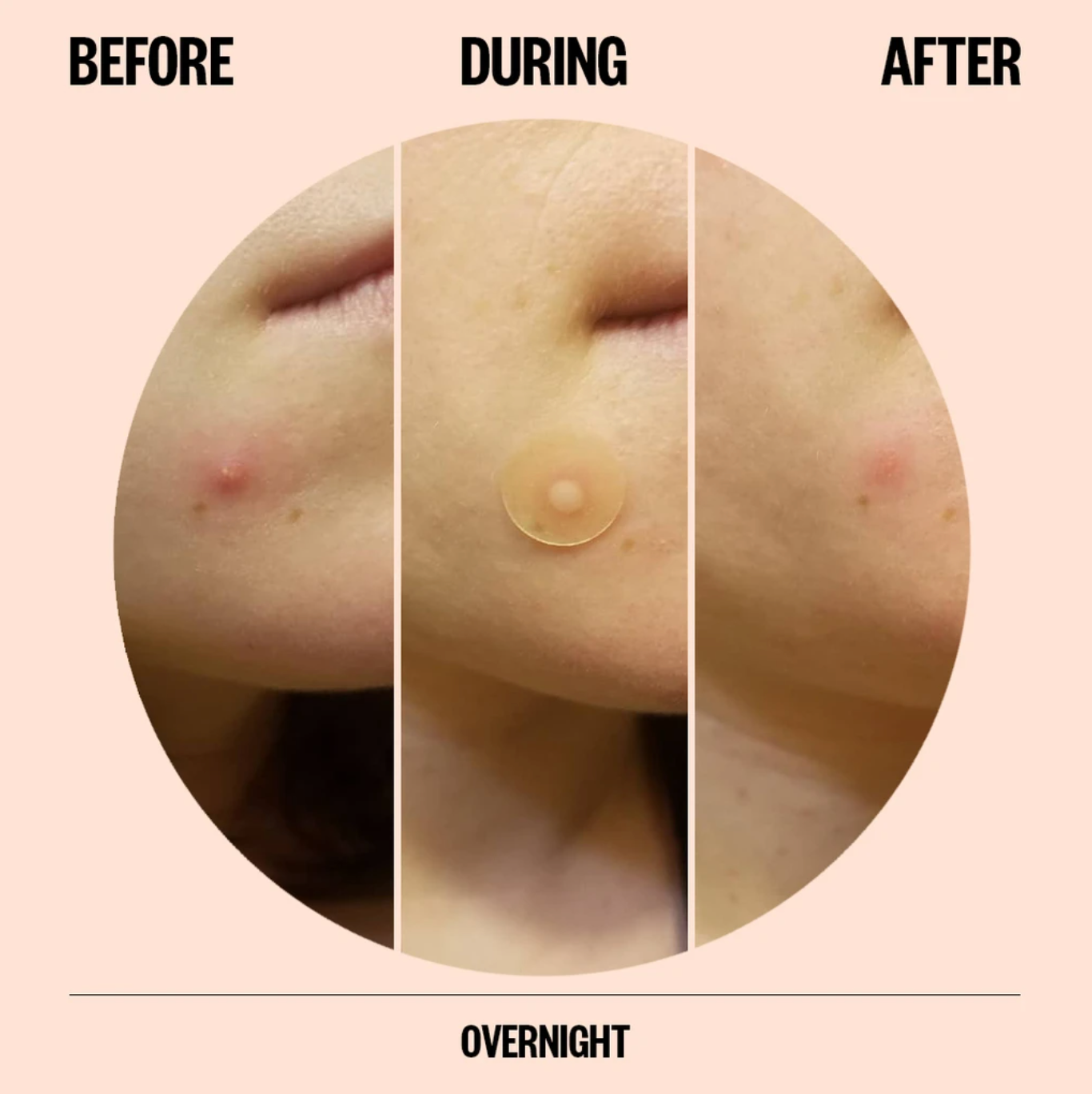 Bubble Super Clear Acne Treating Serum - Cassandra Bankson